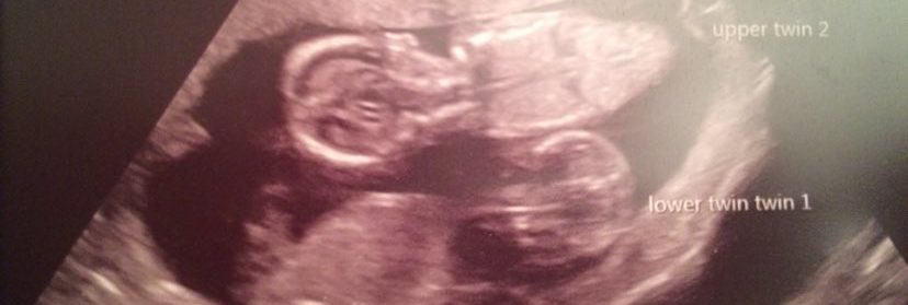 Twin_scan_pic_-_12_weeks1-e1626253591842